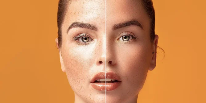 Lézeres pigmentfolt eltávolítás Apollon Beauty kozmetikában